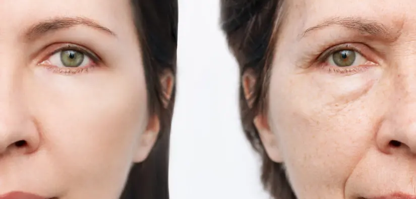 What is Liquid Facelift?