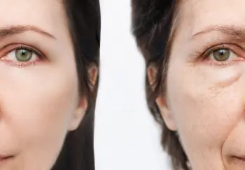 What is Liquid Facelift?
