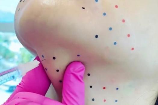 Gıdı ve Yanak İnceltme